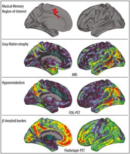 El gráfico muestra (en rojo, arriba) el giro cingulado anterior donde se almacenan los recuerdos musicales. Más abajo, visión bilateral de tres biomarcadores de Alzhéimer, en rojo las más afectadas. / MPI F. HUMAN COGNITIVE AND BRAIN SCIENCES